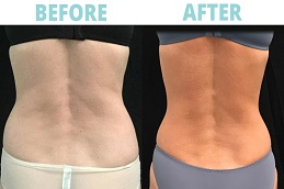 أفضل جراحة نحت الجسم بتقنية سكالبشور في الرياض