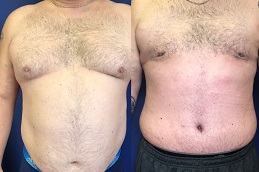 أفضل جراحة نحت الجسم عالي الدقة في الرياض