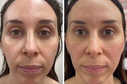 أفضل جراحة نحت الوجه في الرياض