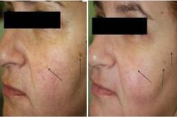 أفضل جراحة وجه بالأكسجين في الرياض