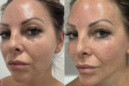 أفضل جلسة أكواغولد فاين تاتش للوجه في الرياض