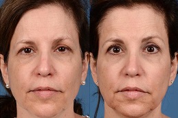 أفضل علاج لجراحة الوجه بالليزر في الرياض