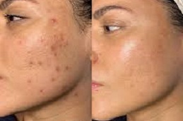 أفضل علاج لندبات حب الشباب باستخدام ترددات الراديو في الرياض