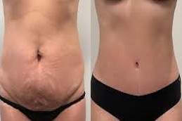 أفضل علاج ليبوماتيك في الرياض، جراحة في الرياض