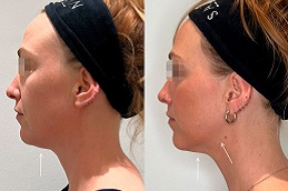 أفضل علاج نفرتيتي لشد الفك في الرياض