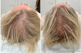 أفضل عمليات فيلر الشعر في الرياض