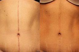 أفضل مراكز علاج ندوب ما بعد الجراحة في الرياض