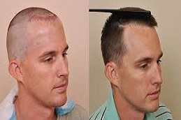 أفضل مركز زراعة شعر في بريدة والقصيم