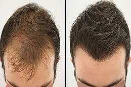 أفضل مزارع شعر في الدمام بالرياض