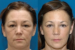 إزالة أكياس العين في الرياض والمملكة العربية السعودية