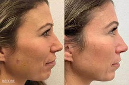 إزالة الآفات الجلدية في الرياض والمملكة العربية السعودية