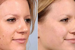 إزالة الآفات الجلدية في الرياض