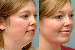 إزالة الذقن المزدوجة في الرياض