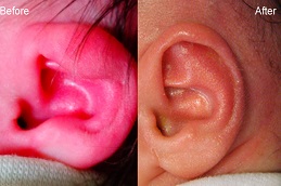 إزالة الزوائد أمام الأذن في الرياض والمملكة العربية السعودية