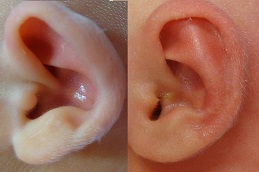 إزالة الزوائد أمام الأذن في الرياض