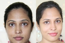 إزالة السمرة في الرياض والمملكة العربية السعودية