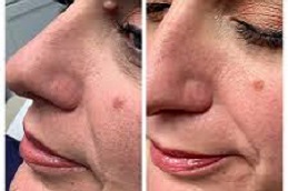 إزالة الشامات في الرياض