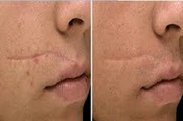 إزالة الندبات بالليزر في الرياض والمملكة العربية السعودية