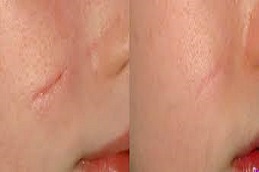 إزالة الندبات بالليزر في الرياض