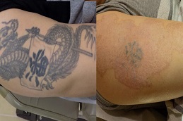 إزالة الوشم بتقنية بيكو شور في الرياض والمملكة العربية السعودية