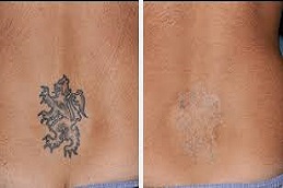 إزالة الوشم بتقنية بيكو شور في الرياض