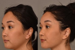 إزالة دهون الخدود في الرياض، المملكة العربية السعودية