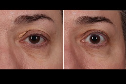 إزالة زانثلازما الجفن في الرياض