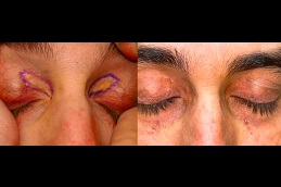 إزالة زانثلازما الجفن في الرياض، المملكة العربية السعودية