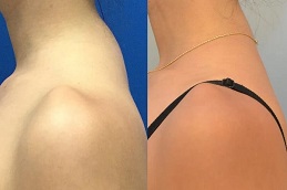 إزالة سنام الجاموس في الرياض والمملكة العربية السعودية