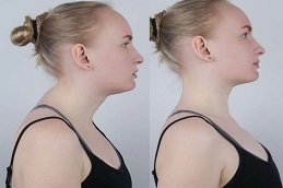 إزالة سنام الجاموس في الرياض