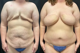 إعادة بناء الثدي بتقنية DIEP Flap في الرياض والمملكة العربية السعودية