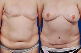 إعادة بناء الثدي بتقنية DIEP Flap في الرياض