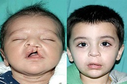 التشوهات الخلقية في الرياض والمملكة العربية السعودية