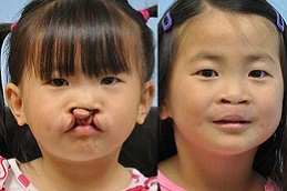 التشوهات الخلقية في الرياض