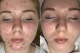 التقشير الأخضر في الرياض والمملكة العربية السعودية