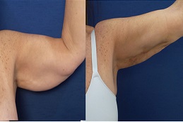 بلازما جيه للفخذين والذراعين في الرياض والمملكة العربية السعودية