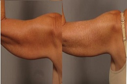 بلازما جيه للفخذين والذراعين في الرياض