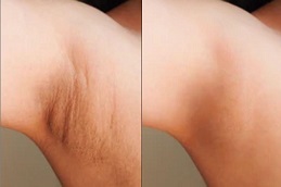 بوتوكس الإبط في الرياض والمملكة العربية السعودية