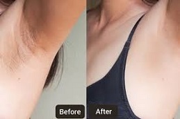 بوتوكس الإبط في الرياض