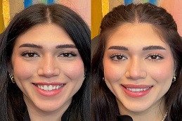 بوتوكس لتكبير الشفاه في الرياض والمملكة العربية السعودية