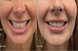 بوتوكس لتكبير الشفاه في الرياض