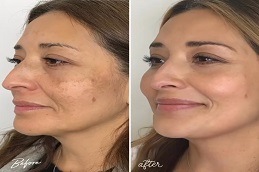 تبييض دائم للبشرة في الرياض والمملكة العربية السعودية