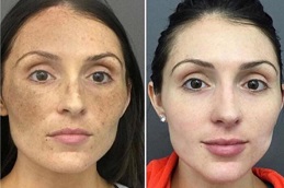 تبييض دائم للبشرة في الرياض