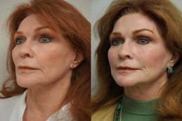 تجديد البشرة بالبلازما في الرياض والمملكة العربية السعودية