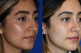 تجميل الأنف المغلق في الرياض والمملكة العربية السعودية