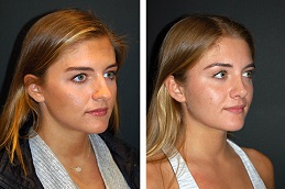 تجميل الأنف المغلق في الرياض