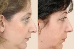 تجميل الأنف في الرياض