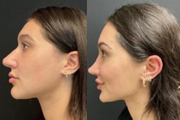 تجميل الأنف في الرياض