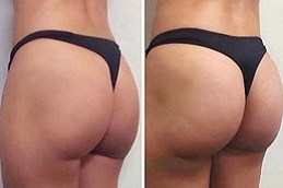 تجميل المؤخرة الفرنسية في الرياض