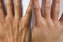 تجميل اليدين في الرياض والمملكة العربية السعودية